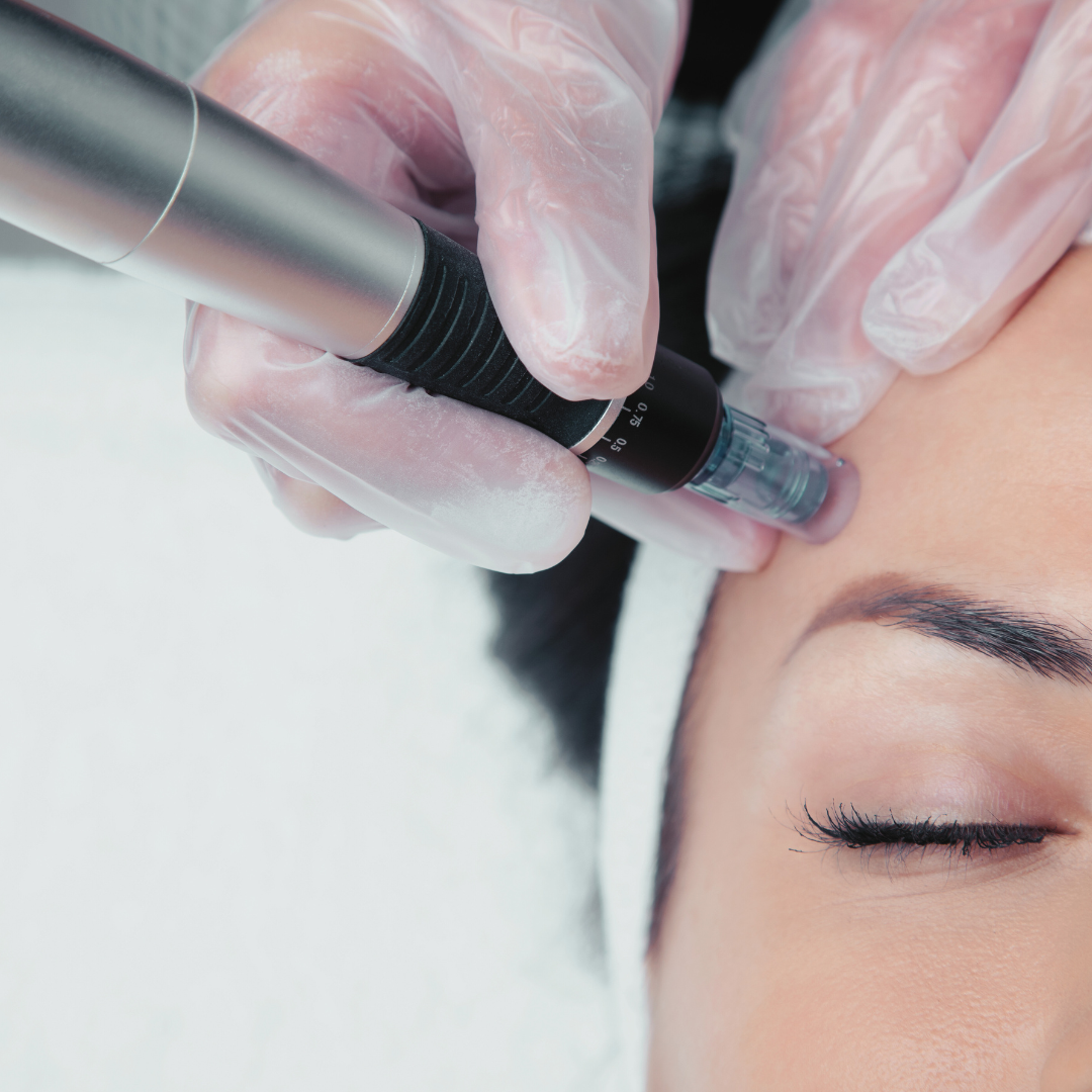 Advanced Needling Image